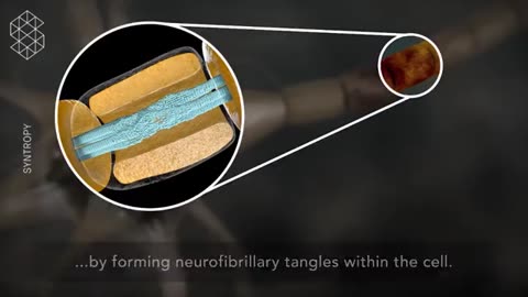 The effects of a concussion on brain cells