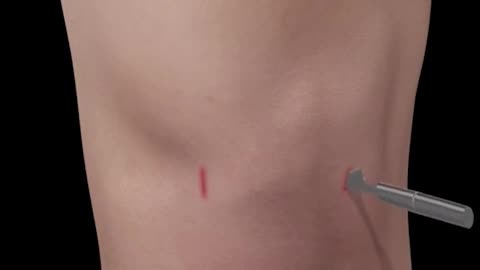 Loose Body Removal 3D Animation