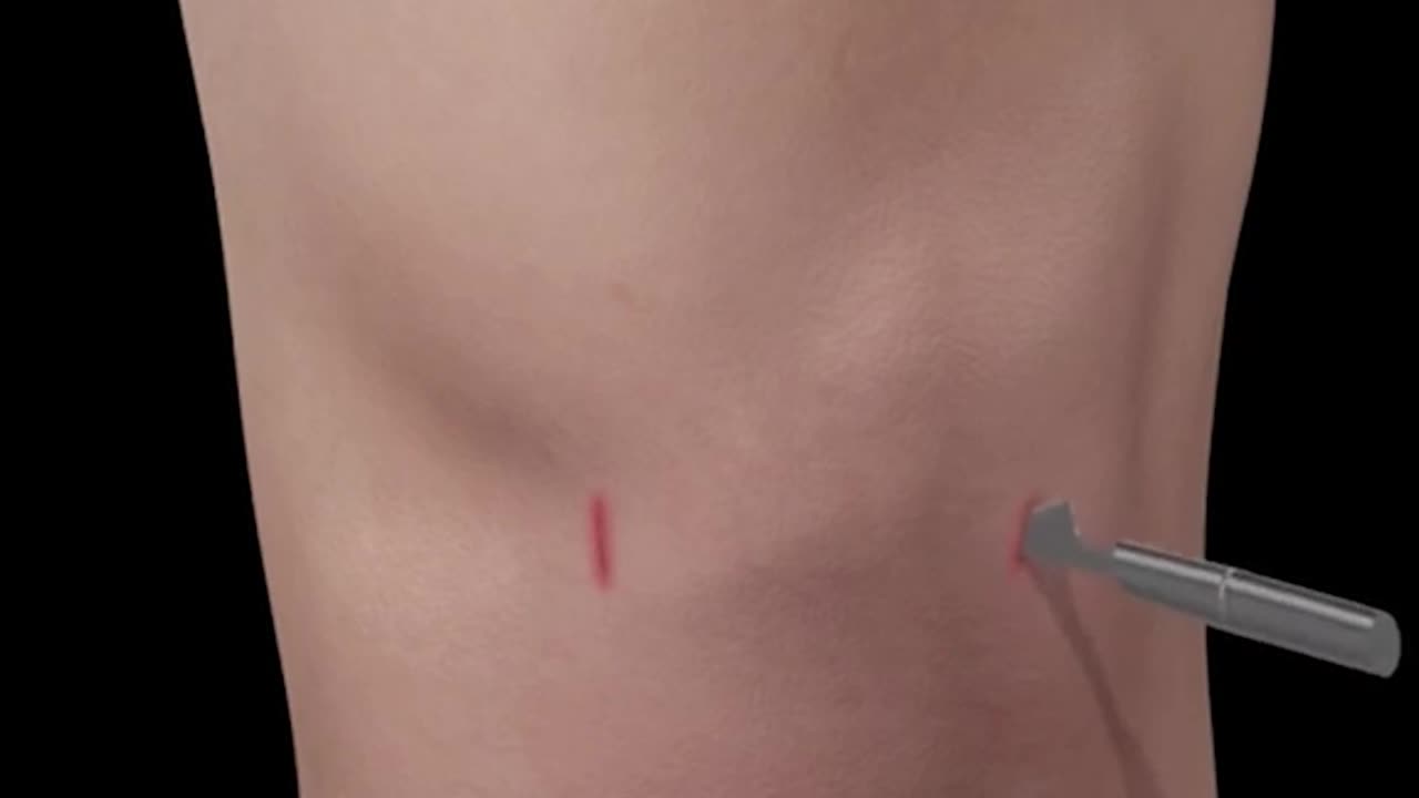 Loose Body Removal 3D Animation