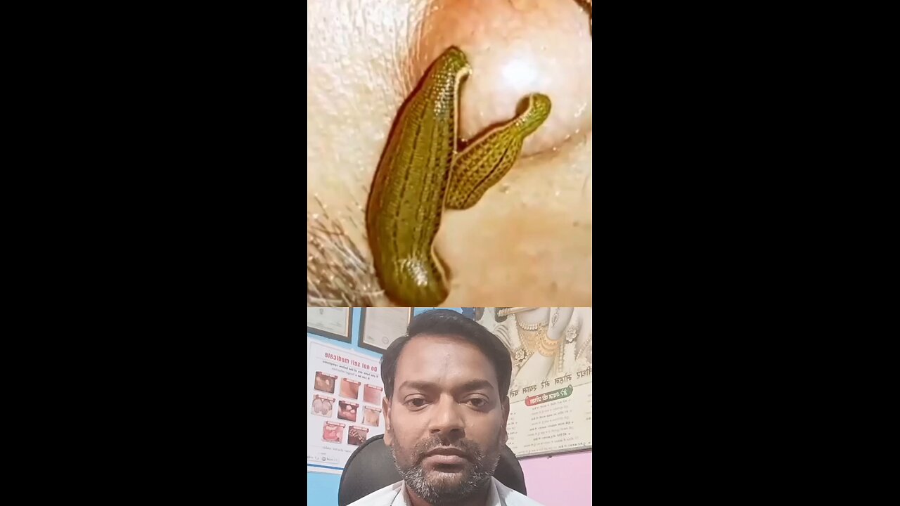 जोंक से कैंसर का इलाज ।