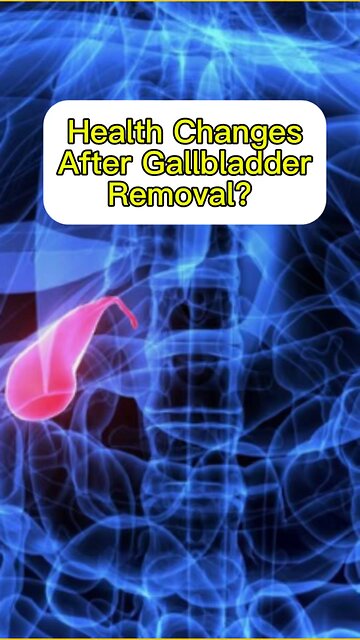 Gallbladder Removed? Here’s what can happen!