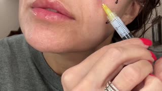 Round 5 Miracle L Liquid PCL Facelift