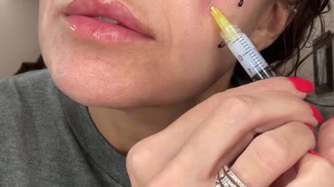 Round 5 Miracle L Liquid PCL Facelift