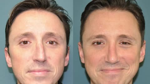 Rhinoplasty for the deviated nose