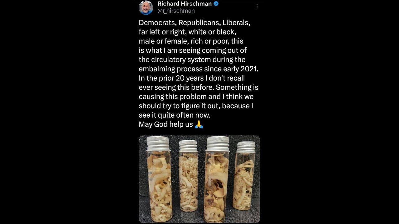 Embalmers Report Persistent Blood Clots in Corpses Since COVID 19 virus Vaccine Roll Out!