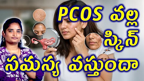 PCOS వల్ల స్కిన్ సమస్య వస్తుందా Does PCOS Cause Skin Problems | Polycystic Ovary Homeopathy Medicine