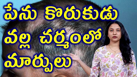 పేను కొరుకుడు వల్ల చర్మంలో మార్పులు Body Changes Due to Alopecia Areata or SpotBaldness Homeopathy