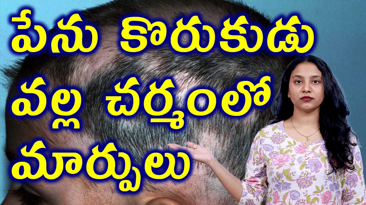 పేను కొరుకుడు వల్ల చర్మంలో మార్పులు Body Changes Due to Alopecia Areata or SpotBaldness Homeopathy