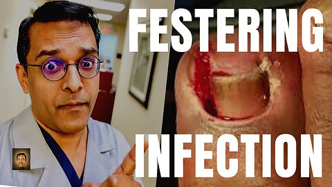 Festering Ingrown Toenail