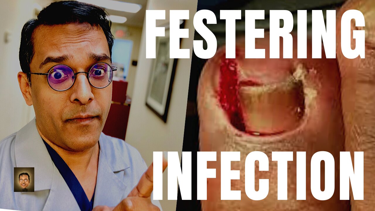 Festering Ingrown Toenail