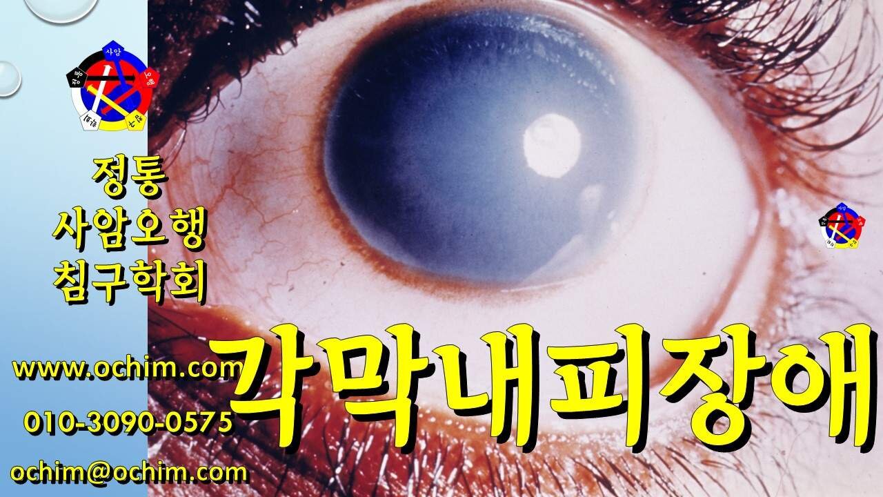 각막내피장애 치료 방법 - 사암오행침, 사암침법, 오행침, 정통사암침