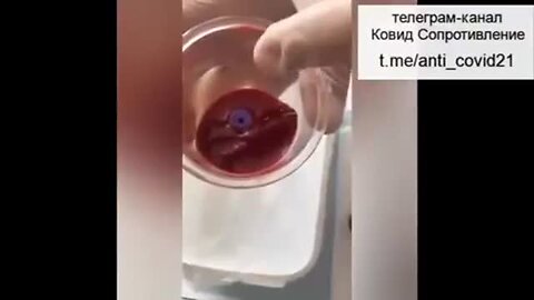 "Chinese Cupping Reveals Vaccine Impact on Blood Consistency, Shows Clot-Like Alteration"