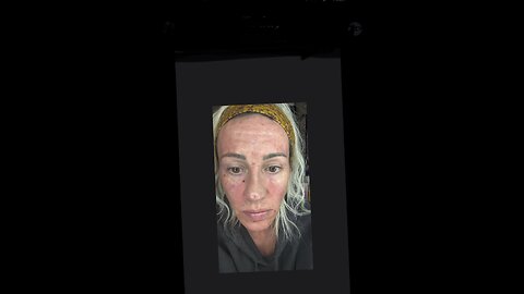 Checkout my links below to see the pro! Sculptra aka plla point to point meso style injections. Dont follow me watch below links PLZ