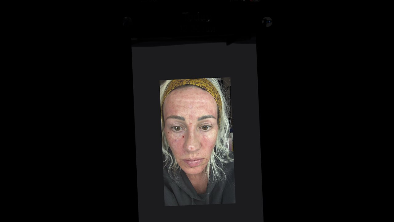 Checkout my links below to see the pro! Sculptra aka plla point to point meso style injections. Dont follow me watch below links PLZ