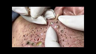 blackhead removal and Pimplepopper Spa relaxation #10118