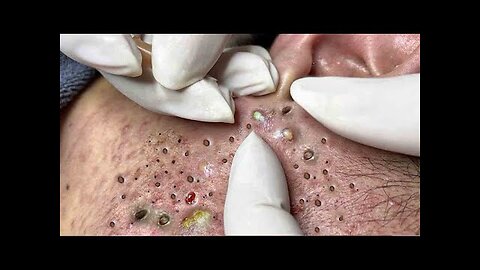 blackhead removal and Pimplepopper Spa relaxation #10118