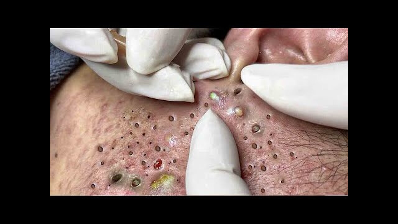 blackhead removal and Pimplepopper Spa relaxation #10118