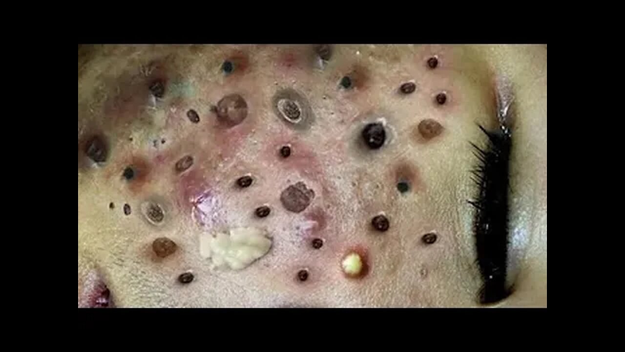 Blackheads Removal & Pimple Popper Cystic Acne Extraction #228