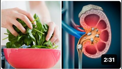 "Misconceptions About Eating Spinach and Potential Kidney Damage"
