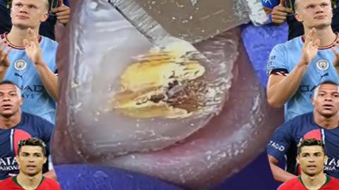 Ingrown Toenail Removal 2025 #ingrowntoenail #toenails #ingrown (23)