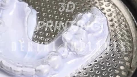 The Future of Dental Implants – 3D Printing in Madurai