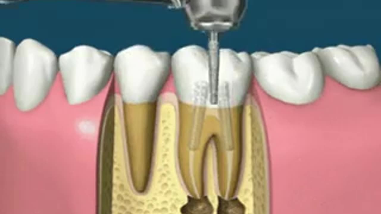 🧠✨ The Amazing Science Behind Root Canals That Save Teeth | FeedMyCuriosity