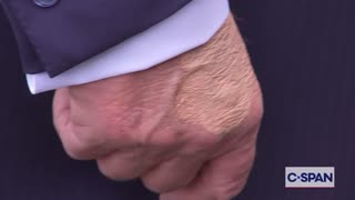 C-SPAN Camera Captures Bruising On President Trump's Hand