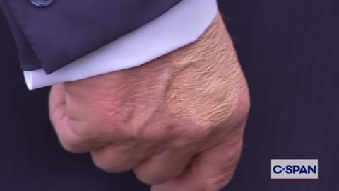 C-SPAN Camera Captures Bruising On President Trump's Hand