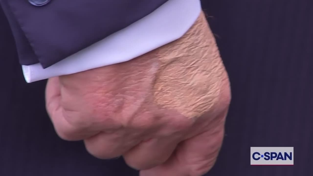 C-SPAN Camera Captures Bruising On President Trump's Hand