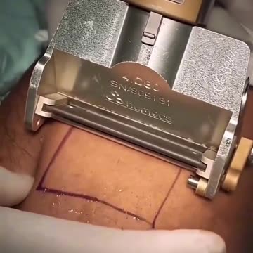 This is what skin grafting looks like - OMG