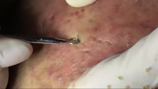 Blackheads Removal & Pimple Popper Cystic Acne Extraction #228