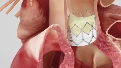 Transcatheter Aortic Valve Implantation Procedure 3D Animation (TAVI)