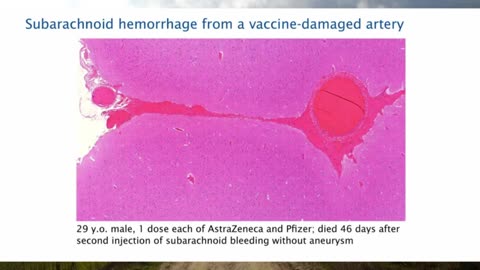Pathologist Arne Burkhardt Final Interview - Revealing the Grave Dangers of mRNA 'Vaccines' (2023)