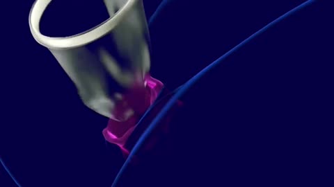 Hysterectomy Procedure 3D Animation