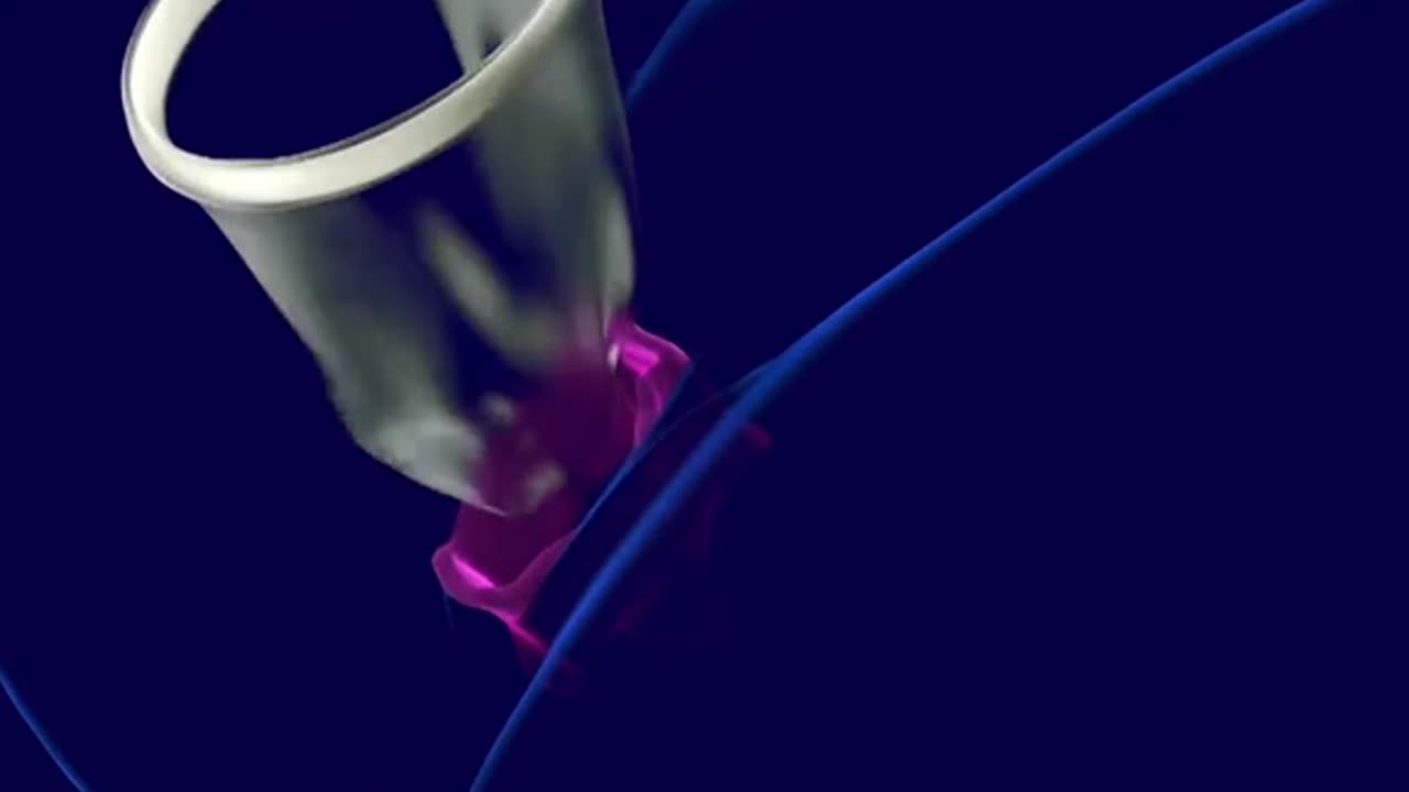 Hysterectomy Procedure 3D Animation