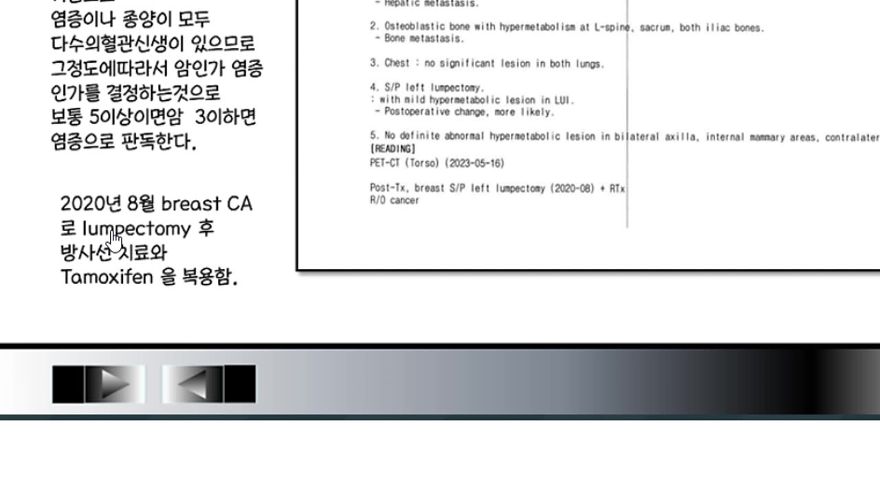 유방암환자 호르몬적인 항암제 치료에서도 프로게스테론부족타목시펜 태음인, 여성호르몬과잉소양인 아로마타제억제제, 소음인이 현격하게 구분된다.