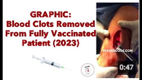 "Graphic: 2023 Blood Clot Removal in Fully Vaccinated Patient ⚠️💉"