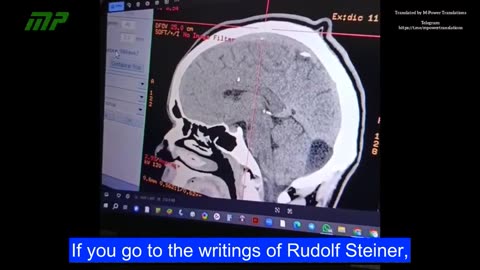 Dr. Xavier Huelmo shows us the neurological damage caused by the COVID-19 vaccine.