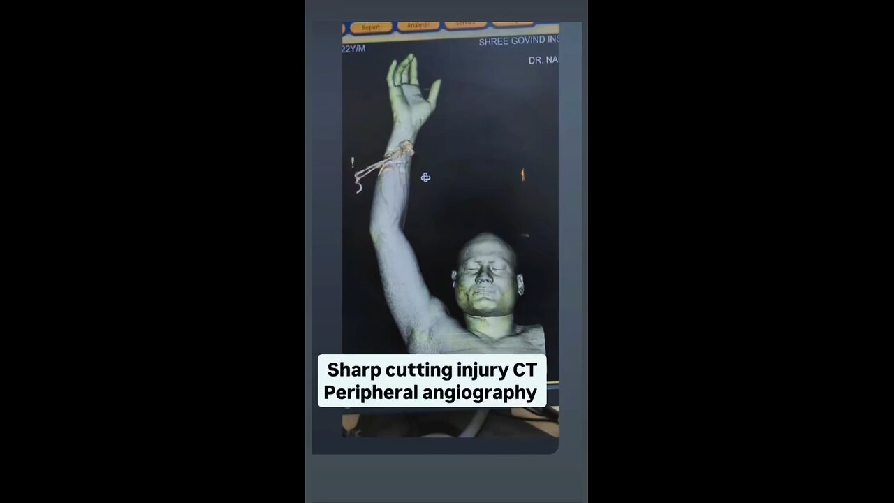 CT peripheral angiography