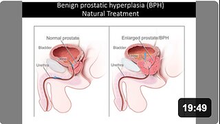 Benign Prostatic Hyperplasia - Natural Treatment