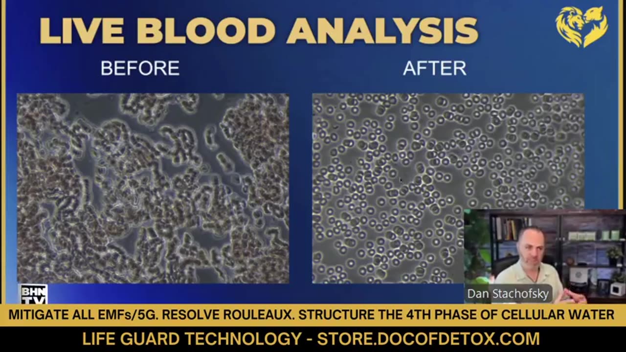 How To Protect Your Blood From 5G, Mitigate EMFs & Resolve Rouleaux