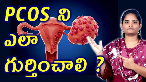 PCOS ఎలా గుర్తించాలి? | Polycystic Ovary Syndrome Signs, Causes & Complete Homeopathy Medicine Cure