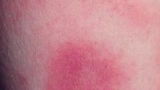 Lyme Disease Diagnosis: Justin Timberlake’s Emotional Health Reveal