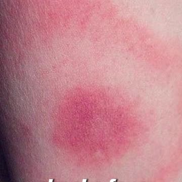 Lyme Disease Diagnosis: Justin Timberlake’s Emotional Health Reveal