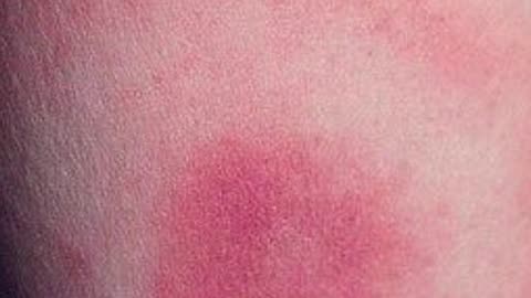 Lyme Disease Diagnosis: Justin Timberlake’s Emotional Health Reveal