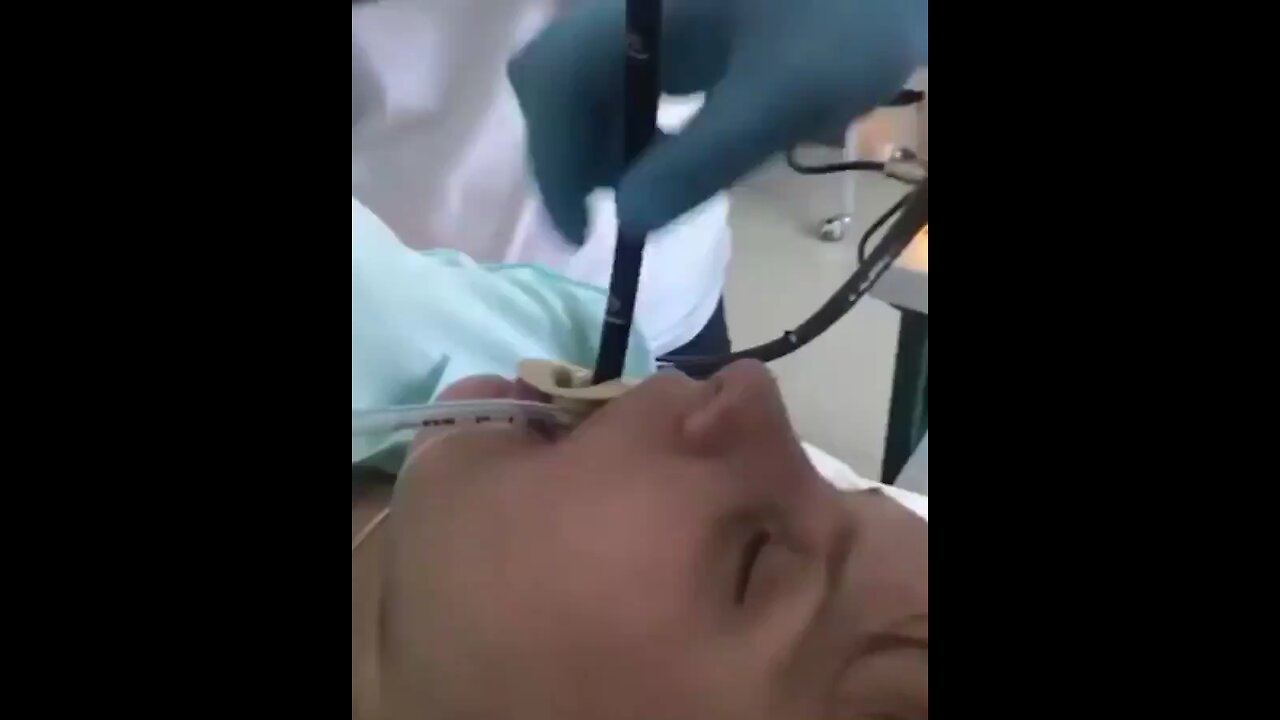 Doctors removing 4 feet snake from women stomach