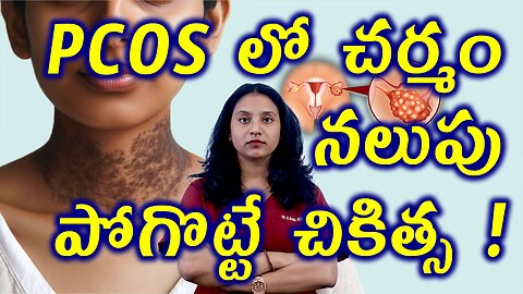 PCOS లో చర్మం నలుపు పోగొట్టే చికిత్స Acanthosis Nigricans Treatment | Cure Dark Neck Naturally Homeo