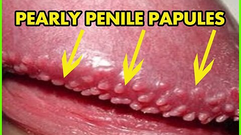 How To Get Rid of Pearly Penile Papules