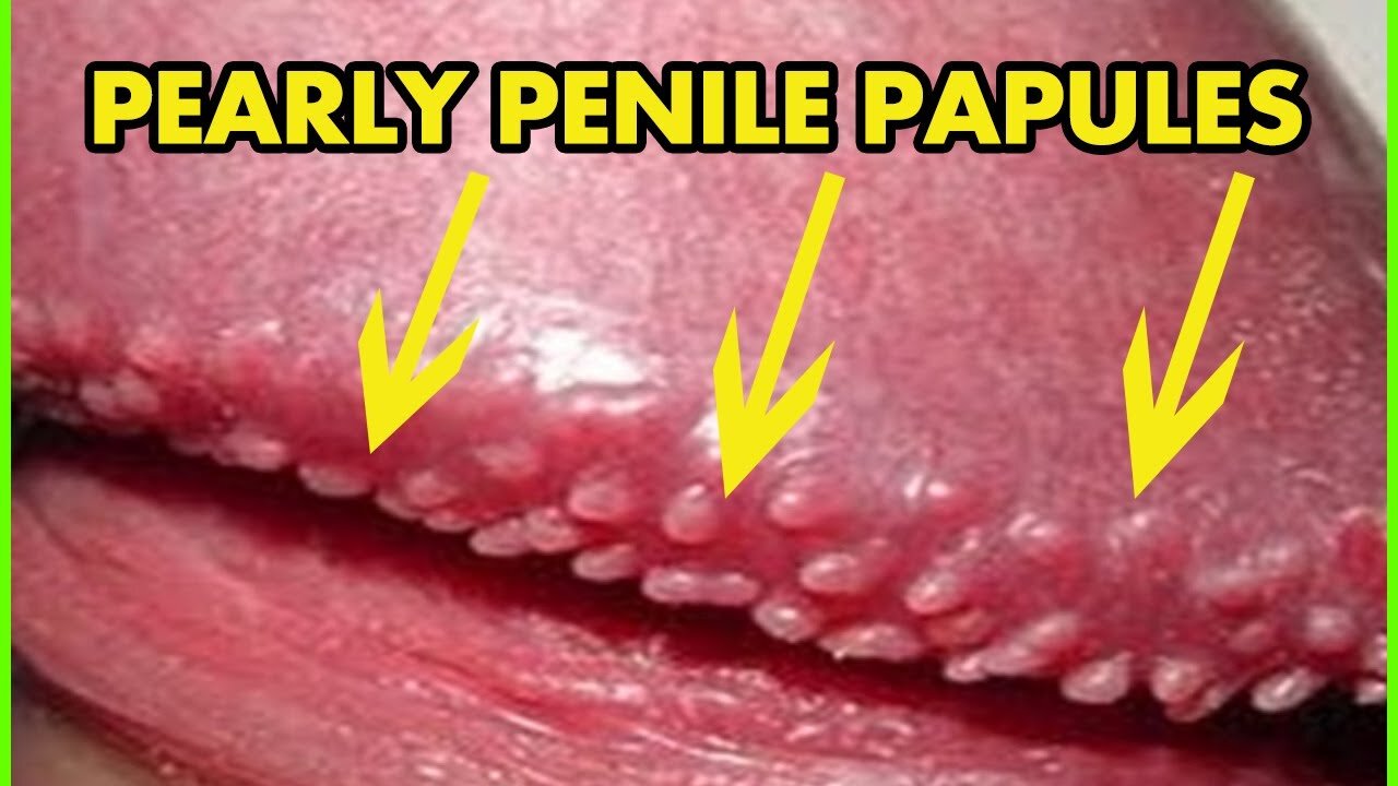 How To Get Rid of Pearly Penile Papules