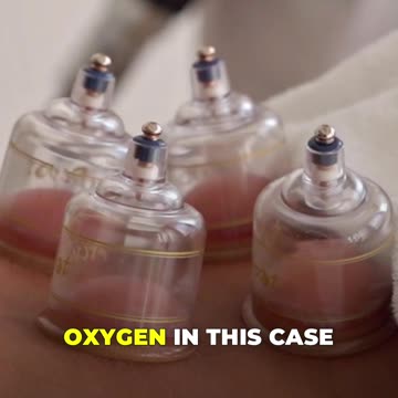 🟣Silicone Cupping: The Vacuum Pump Technique for Pain Relief